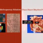 Radiofrequency Ablation