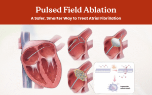 Pulsed Field Ablation: A Safer, Smarter Way to Treat AtrialFibrillation