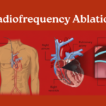 PFA vs. RF Ablation: A New Era in Atrial Fibrillation Treatment—Which is Better?