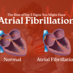 Top 5 Signs You Might Have Atrial Fibrillation—What Your Heart is Trying to Tell You