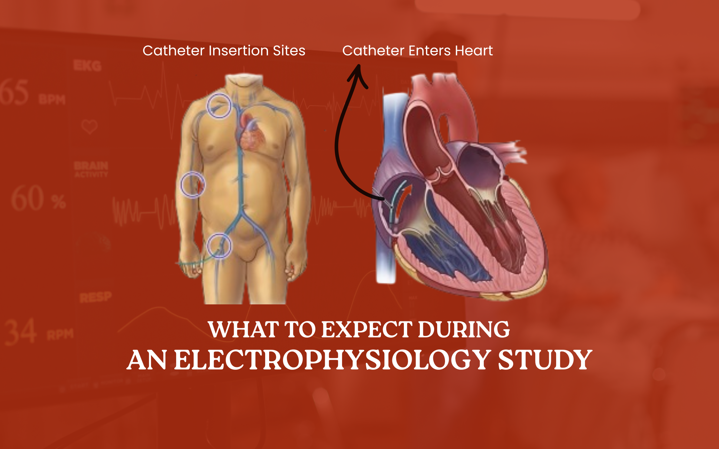 What to Expect During an Electrophysiology Study: Your Guide to the Procedure and Beyond